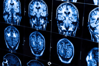 Participate in a Stanford Chronic Pain Study and Receive $200 Cash 3